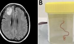 Tıp literatüründe ilk: Beyninden canlı solucan çıkarıldı