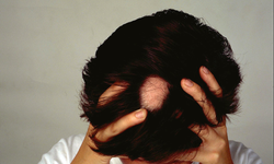 Saç Kıran Hastalığı Hakkında Bilmeniz Gerekenler
