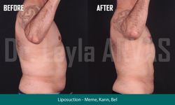 Vaser Liposuction ile Vücut Hatlarınızı Yeniden Keşfedin