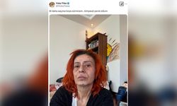 Yıldız Tilbe'nin Yüzündeki Yanık İzleri Hayranlarını Endişelendirdi