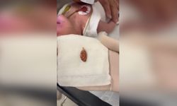 Yemek Borusuna Takılan Badem Şekeri Operasyonla Başarıyla Çıkarıldı