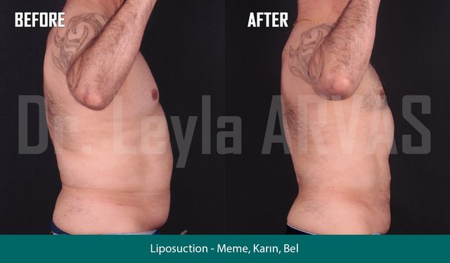 Vaser Liposuction ile Vücut Hatlarınızı Yeniden Keşfedin