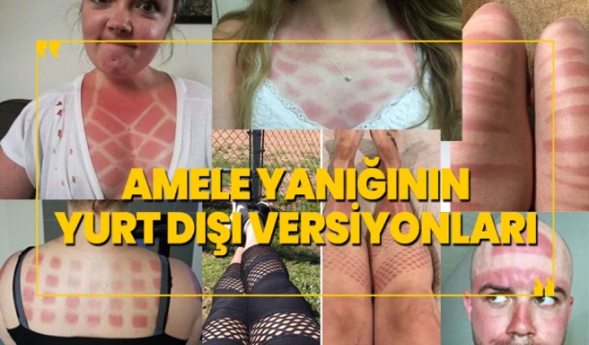 Amele yanığının yurt dışı versiyonları