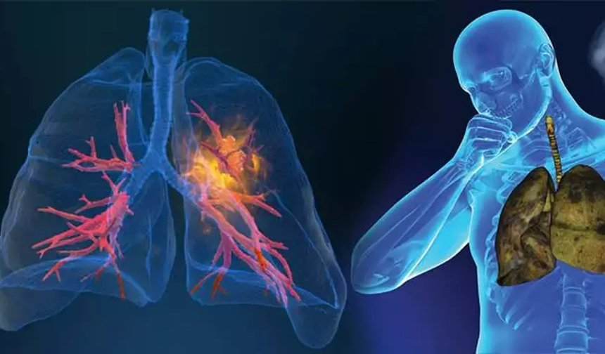Akciğer kanseri ölümleri yüzde 20 azalıyor