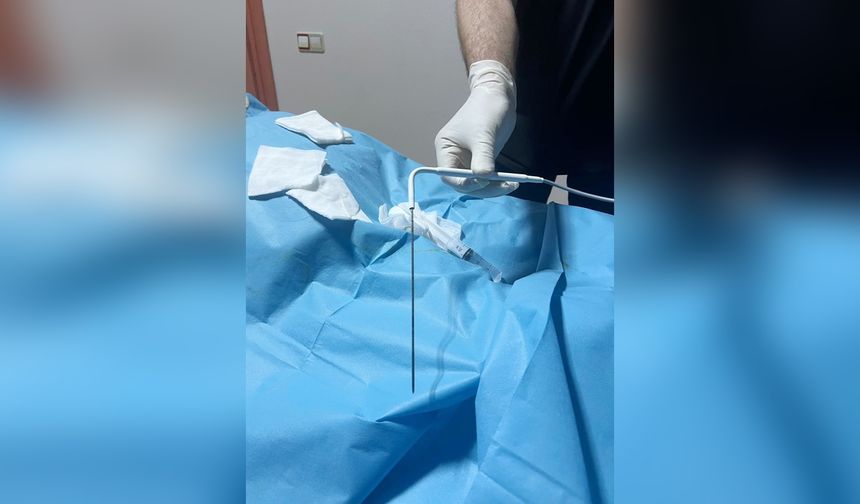Ameliyat Edilemeyen Tümörler Yeni Yöntemle Dondurularak Yok Ediliyor