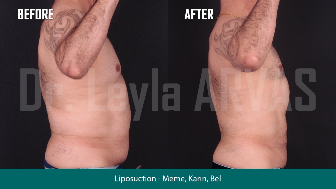 Vaser Liposuction